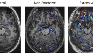 ‘Leaky’ brain barrier a key link between head trauma and brain disease, study finds – The Irish Times