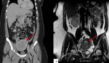 Metastatic Epithelioid Trophoblastic Tumor Following Incomplete Methotrexate Therapy for Ectopic Pregnancy: A Case Report and Multimodal Management