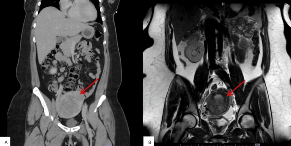 Metastatic Epithelioid Trophoblastic Tumor Following Incomplete Methotrexate Therapy for Ectopic Pregnancy: A Case Report and Multimodal Management