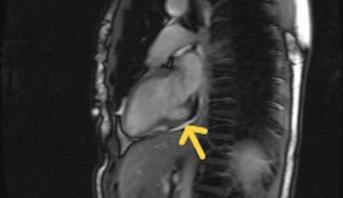 A Benign Outpouching Masquerading as a Scar: A Case of an Incidentally Diagnosed Cardiac Diverticulum