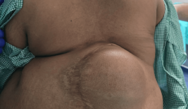 Remifentanil-Based Monitored Anesthesia Care in a Paraplegic Patient With Severe Kyphoscoliosis, Non-palpable Spinal Landmarks, and Coagulation Abnormality Undergoing Ischiorectal Abscess Drainage: A Case Report