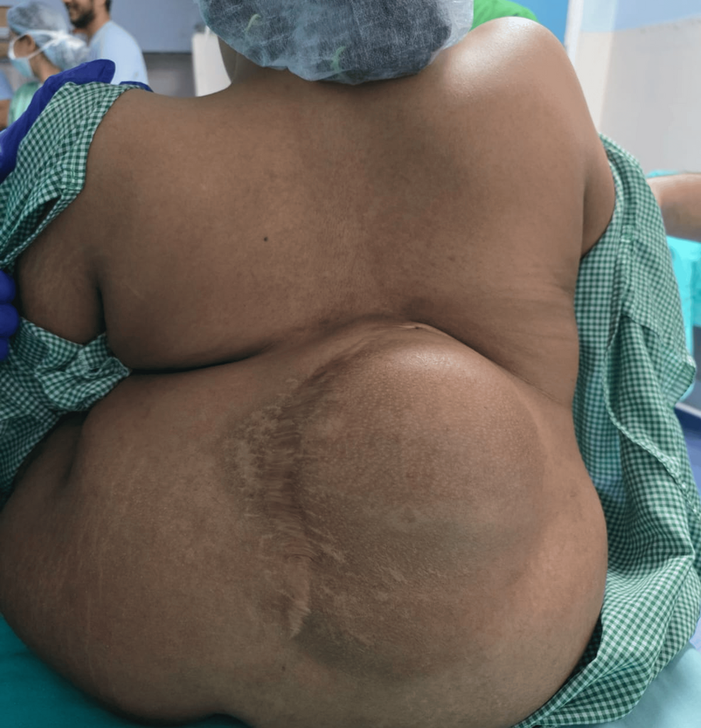 Remifentanil-Based Monitored Anesthesia Care in a Paraplegic Patient With Severe Kyphoscoliosis, Non-palpable Spinal Landmarks, and Coagulation Abnormality Undergoing Ischiorectal Abscess Drainage: A Case Report