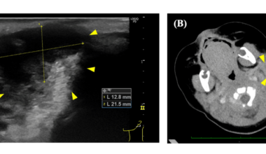 Excessive Inflammatory Response to Bacterial Lymphadenitis in an Infant With A Family History of Recurrent Lymph Node Swelling: A Case Report
