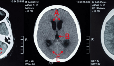 Listeria monocytogenes Meningitis With Hydrocephalus in a Patient With Sjögren’s Syndrome and Penicillin Allergy