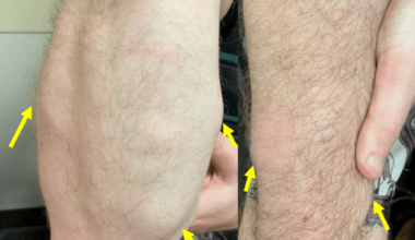 Angiolipomatous Atypical Presentation of Dercum’s Disease