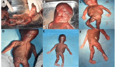 Spectrum of Chromosomal Abnormalities in Abortus and Medically Terminated Fetal Samples From a Tertiary Care Center in the Sub-Himalayan Region of North India