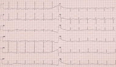 Management Dilemma of an Asymptomatic Carotid Web in a High-Risk Patient: A Case Report
