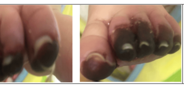 Infantile Kawasaki Disease Mimicking Polyarteritis Nodosa With Severe Ischemic Complications: A Case Report