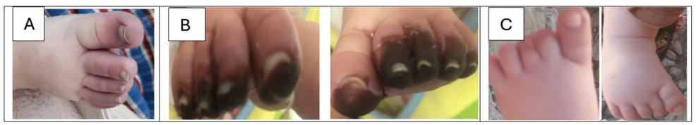 Infantile Kawasaki Disease Mimicking Polyarteritis Nodosa With Severe Ischemic Complications: A Case Report