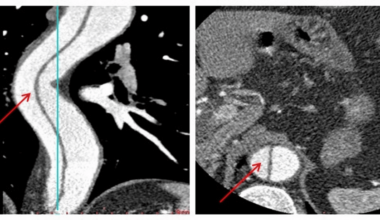 Anesthetic Management of Laparoscopic Surgery in a Patient With an Uncomplicated Type B Aortic Dissection: A Case Report
