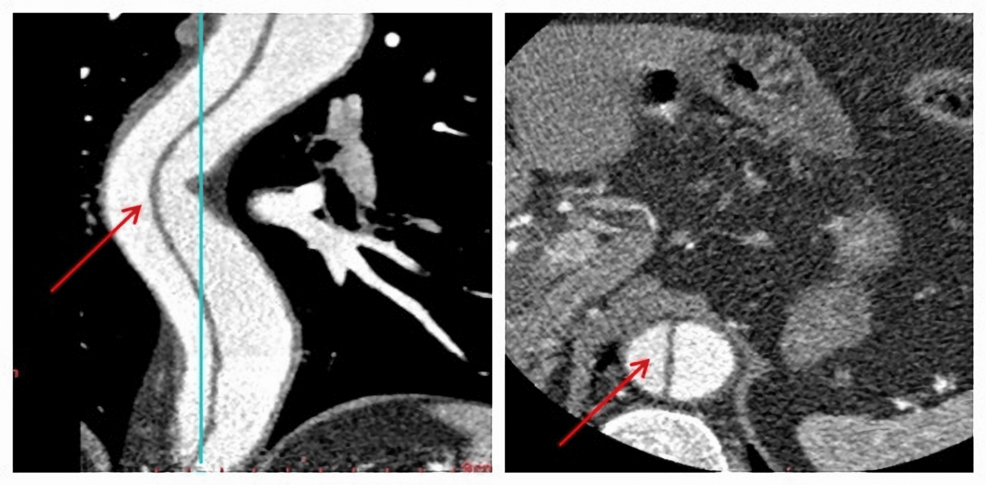 Anesthetic Management of Laparoscopic Surgery in a Patient With an Uncomplicated Type B Aortic Dissection: A Case Report