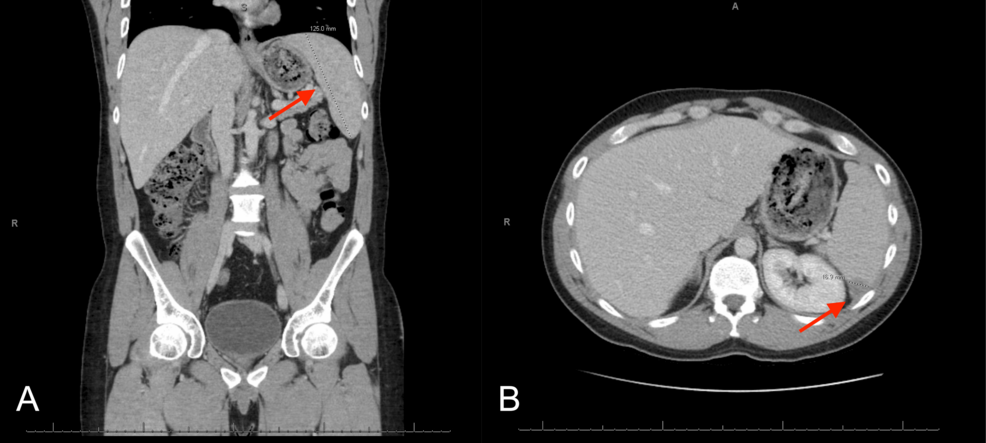 Pulmonary Nodules and Splenic Lesions as Rare Extraintestinal Manifestations of Crohn’s Disease