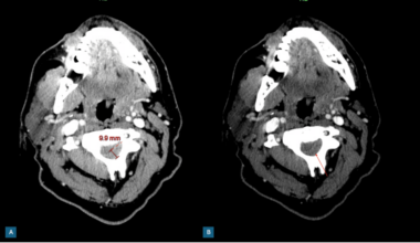 Idiopathic Spontaneous Cervical Epidural Hematoma: A Sudden Neurological Catastrophe