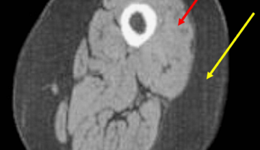 Chronic Obstructive Pulmonary Disease and Overtraining Syndrome: A Narrative Review