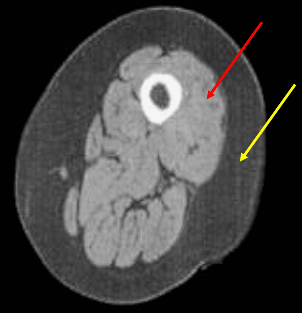 Chronic Obstructive Pulmonary Disease and Overtraining Syndrome: A Narrative Review