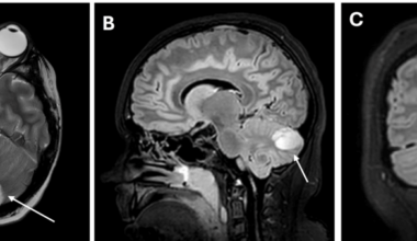Pediatric Meningococcal Meningitis Complicated by Cerebellar Abscess: A Case Report