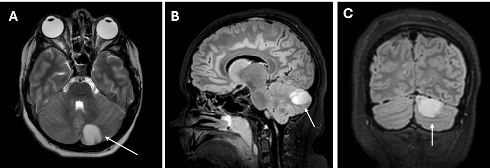 Pediatric Meningococcal Meningitis Complicated by Cerebellar Abscess: A Case Report