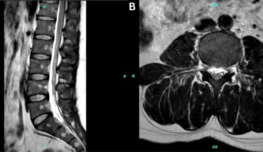 Anterior Horn Cell Disease in Adulthood: Unmasking Spinal Muscular Atrophy Type 4