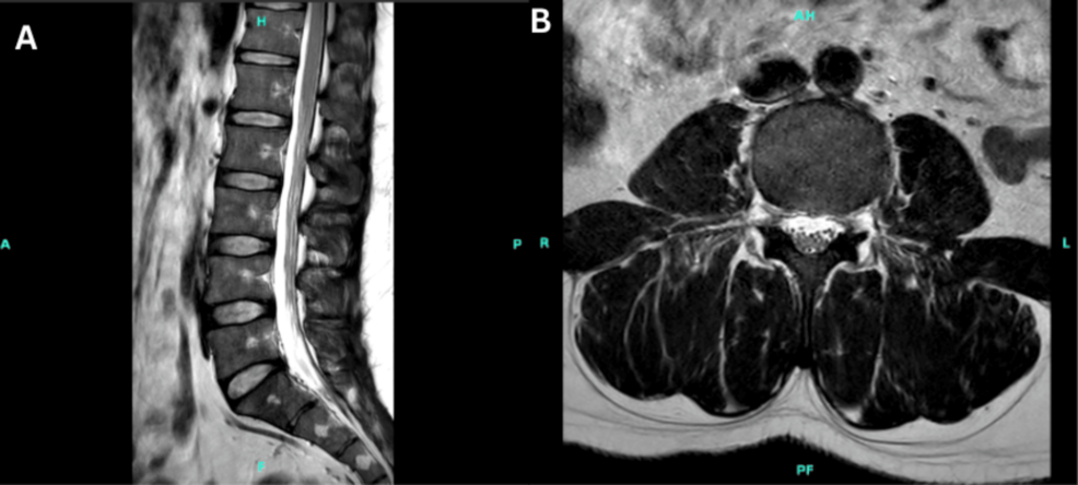 Anterior Horn Cell Disease in Adulthood: Unmasking Spinal Muscular Atrophy Type 4