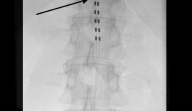 Spinal Cord Stimulation for Chronic Pelvic Pain Secondary to Oncologic Complications: A Case Report