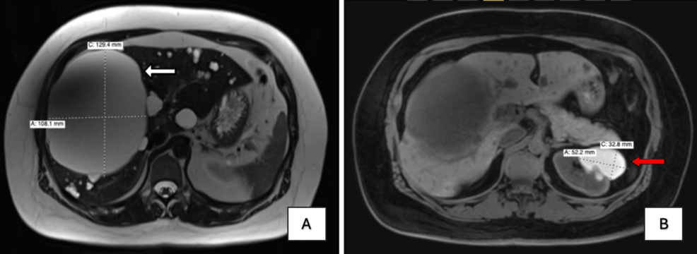 Clinical and Genetic Characterization of a Patient With SEC63-Related Autosomal Dominant Polycystic Liver Disease and an IFT140 Pathogenic Variant Associated With Polycystic Kidney Disease