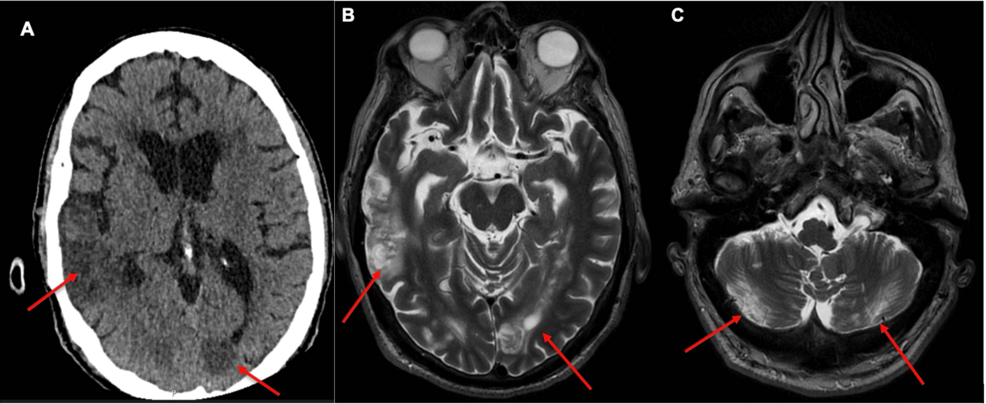 Infective Endocarditis With Negative Cardiac Multimodal Imaging: A Case Report