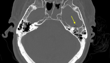 Masked Mastoiditis Presenting As Pneumococcal Meningoencephalitis in an Elderly Patient: A Diagnostic Pitfall in the Emergency Department