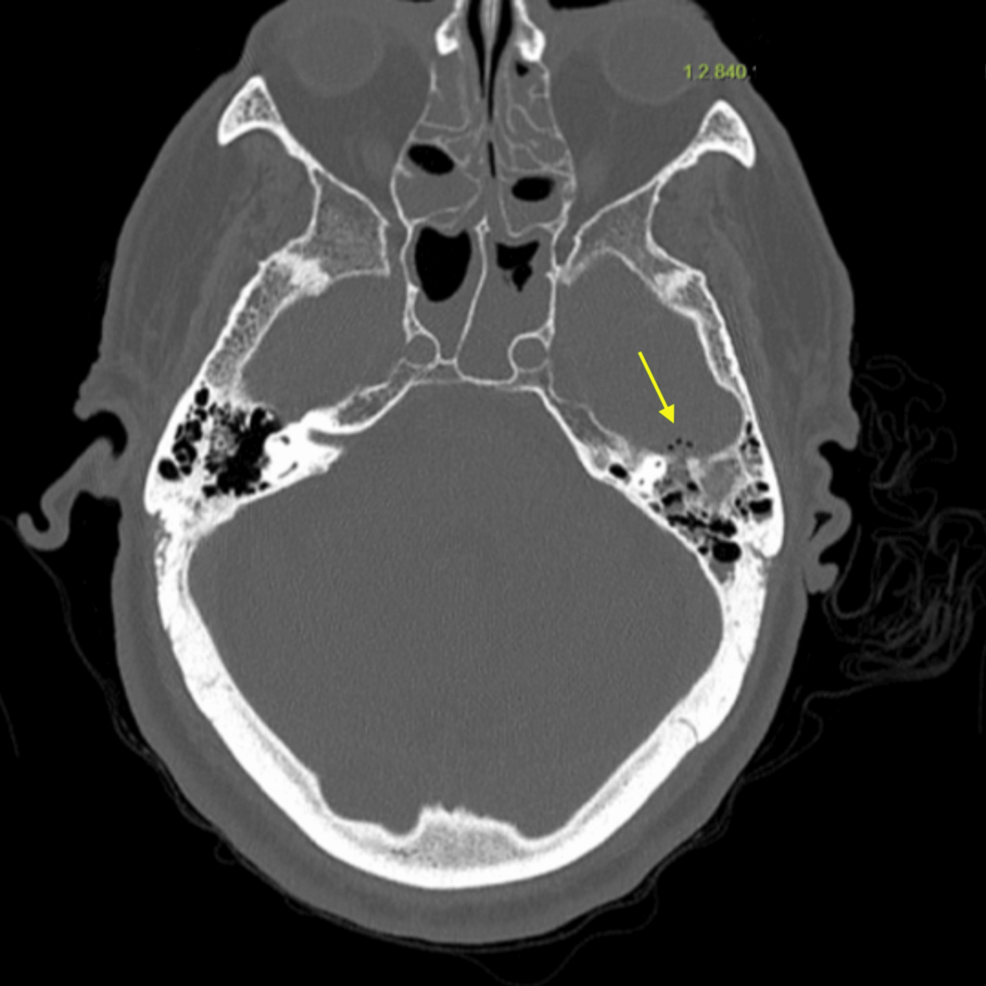Masked Mastoiditis Presenting As Pneumococcal Meningoencephalitis in an Elderly Patient: A Diagnostic Pitfall in the Emergency Department