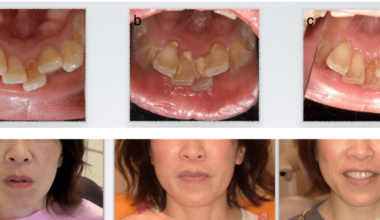 Functional Oral Intervention Associated With Reduced Dental Calculus Formation and Secondary Facial Changes: A Case Report