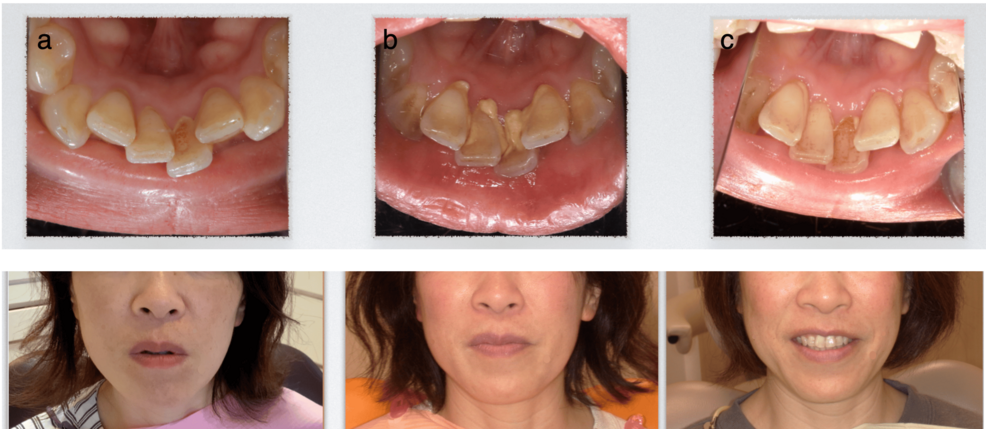 Functional Oral Intervention Associated With Reduced Dental Calculus Formation and Secondary Facial Changes: A Case Report
