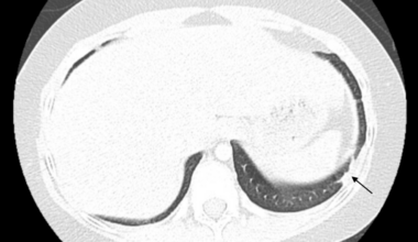 Antineutrophil Cytoplasmic Antibody-Negative Eosinophilic Granulomatosis With Polyangiitis in a Pediatric Patient