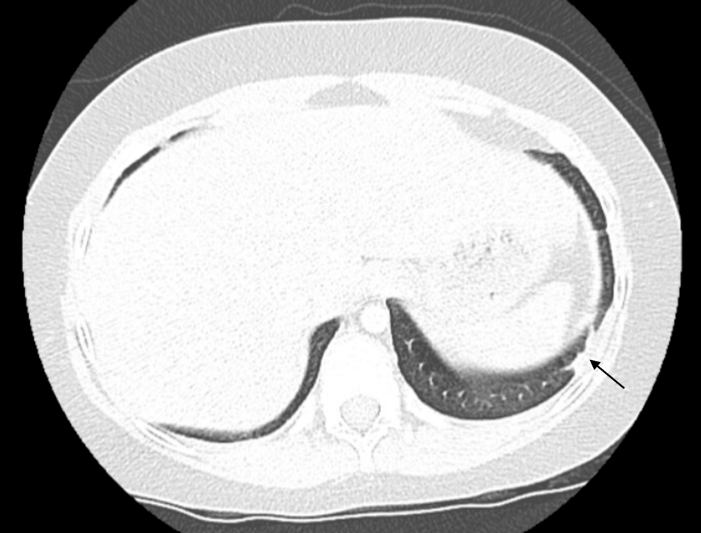 Antineutrophil Cytoplasmic Antibody-Negative Eosinophilic Granulomatosis With Polyangiitis in a Pediatric Patient