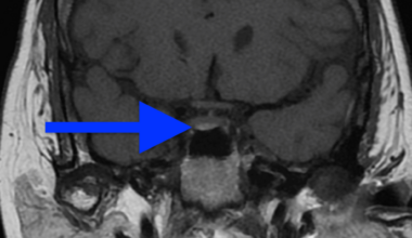 Management of Cushing’s Disease in Pregnancy: A Case Report