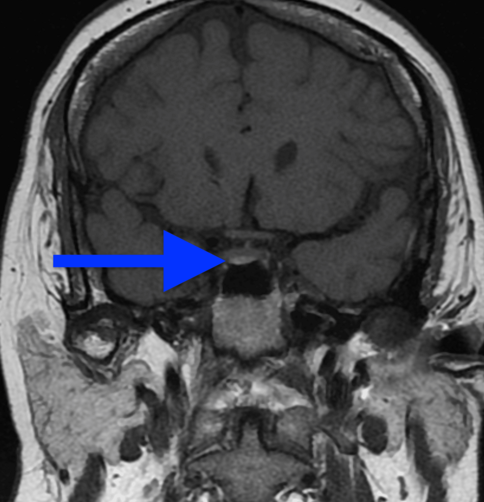 Management of Cushing’s Disease in Pregnancy: A Case Report