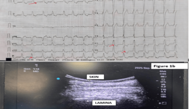 Anesthetic Management of Modified Radical Mastectomy in a Patient With Severe Dilated Cardiomyopathy: A Case Report