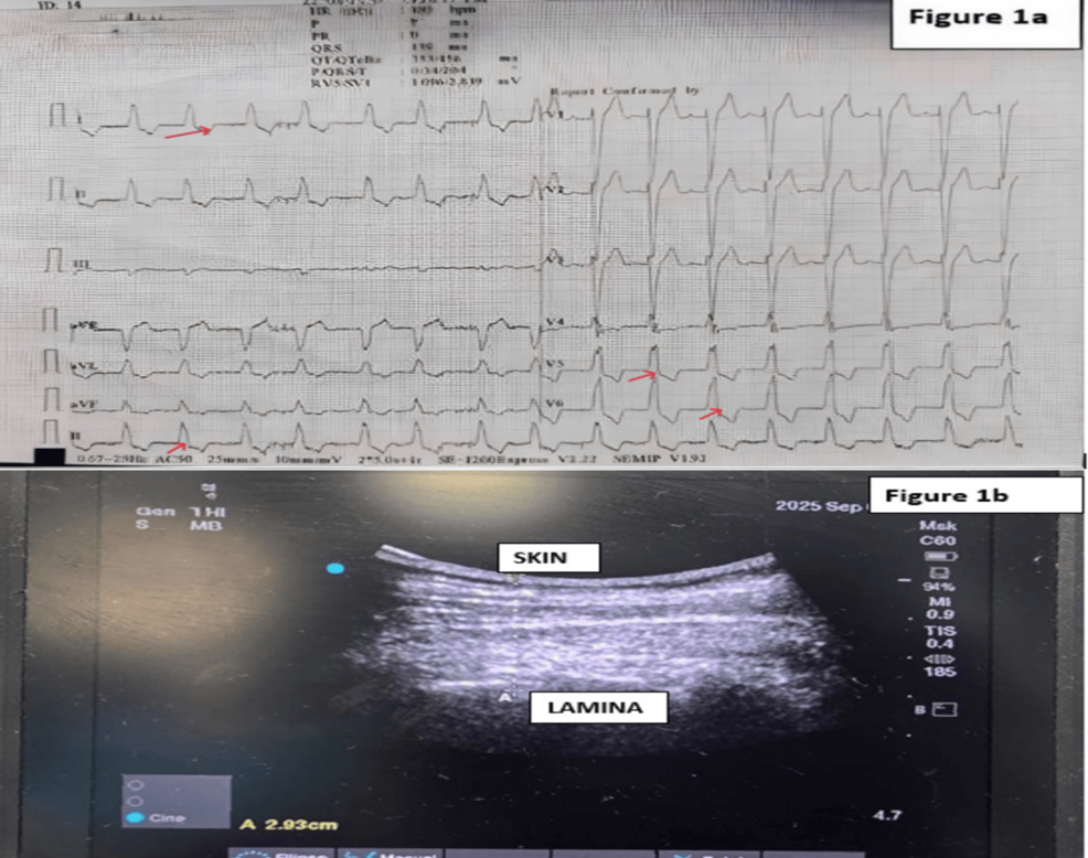 Anesthetic Management of Modified Radical Mastectomy in a Patient With Severe Dilated Cardiomyopathy: A Case Report