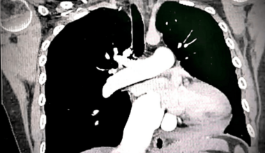 Chronic Thromboembolic Pulmonary Hypertension in a Patient With Systemic Lupus Erythematosus and Antiphospholipid Syndrome: A Case of Surgical Management With Pulmonary Endarterectomy