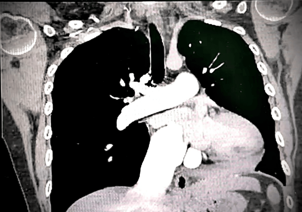 Chronic Thromboembolic Pulmonary Hypertension in a Patient With Systemic Lupus Erythematosus and Antiphospholipid Syndrome: A Case of Surgical Management With Pulmonary Endarterectomy