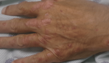 A Diagnostic Pitfall: Secondary Syphilis Mimicking Psoriasis in a Patient With Alcoholic Liver Disease