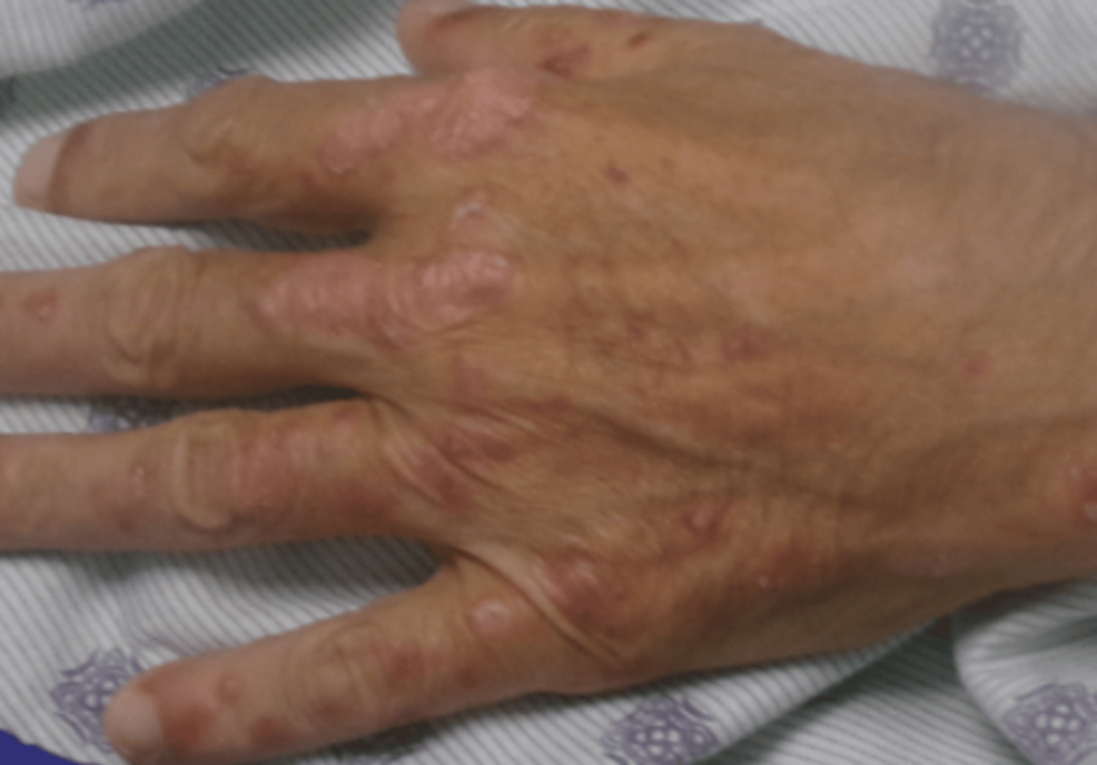 A Diagnostic Pitfall: Secondary Syphilis Mimicking Psoriasis in a Patient With Alcoholic Liver Disease