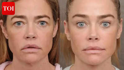 Denise Richards opens up about facelift; surgeon hails actress for bravely sharing 'before and after' pics