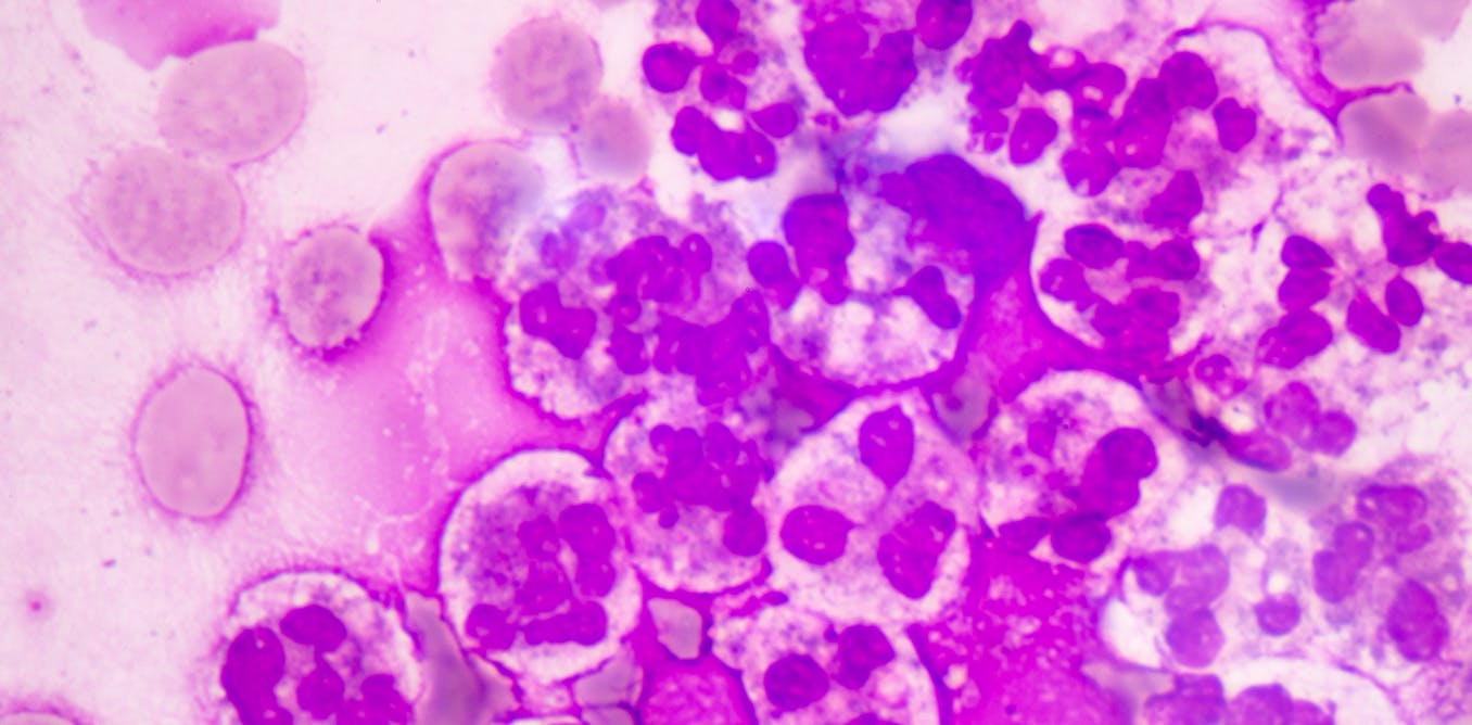 Why sepsis is becoming harder to treat in Europe