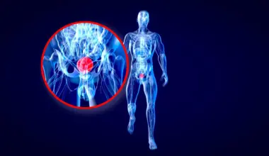 Stanford scientists say colorblindness may hide a deadly bladder cancer warning