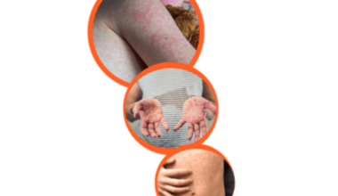 Manitoba Health identifies additional measles exposure sites in region - PembinaValleyOnline.com