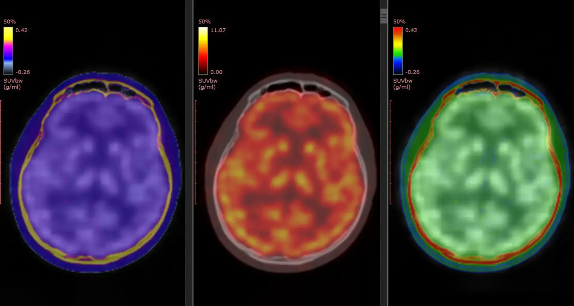 Brain scans reveal how ketamine quickly lifts severe depression