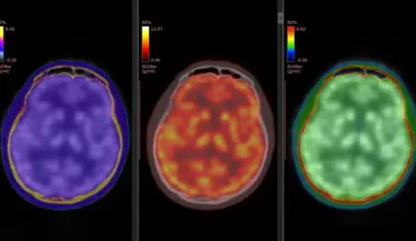 Brain scans reveal how ketamine quickly lifts severe depression