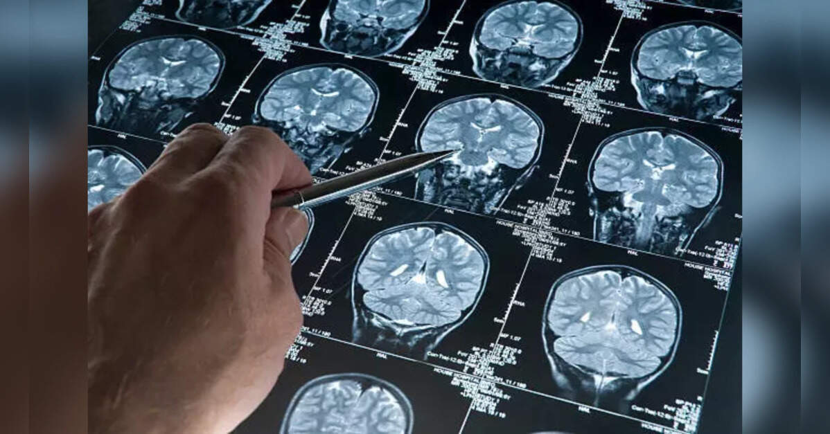 Study Links Parkinson's Protein to Accelerated Alzheimer's in Women, ETHealthworld