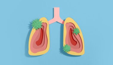 Severe Flu or COVID-19 Could Raise Lung Cancer Risk