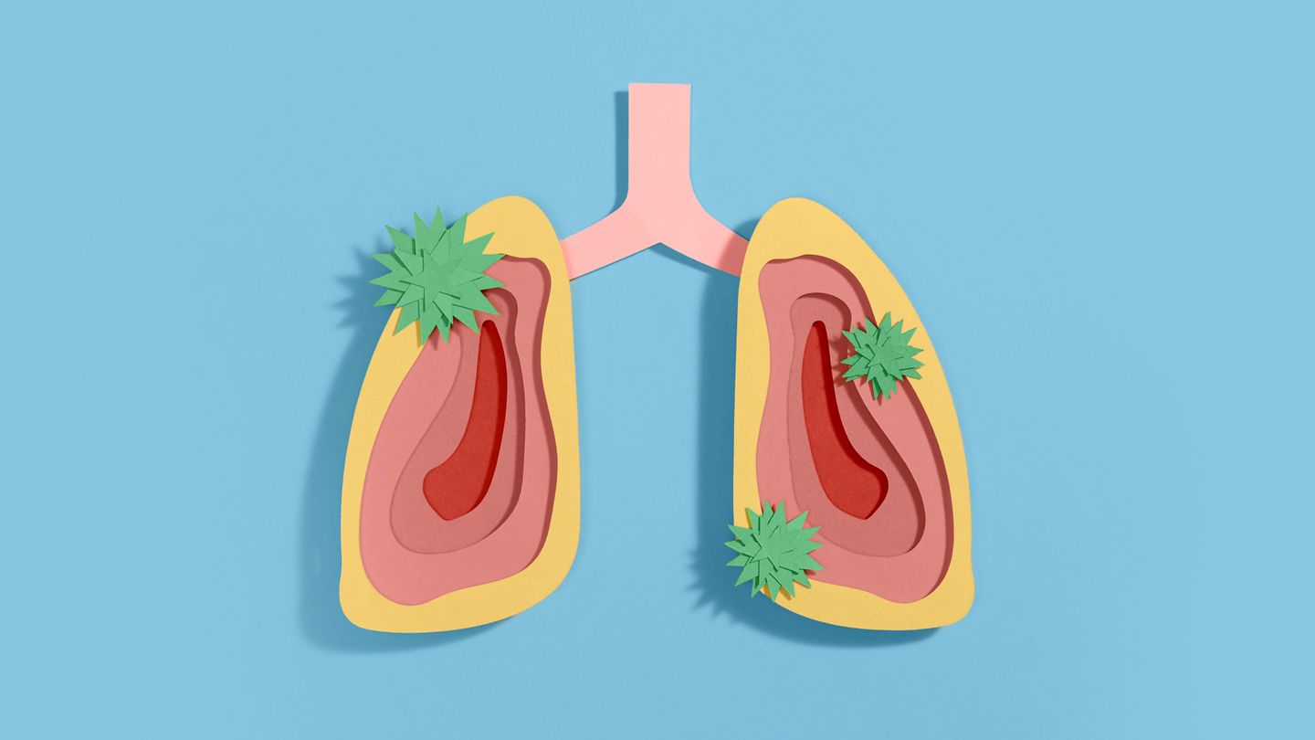 Severe Flu or COVID-19 Could Raise Lung Cancer Risk