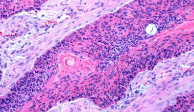 Scientists develop cream that triggers skin’s anti-cancer defence